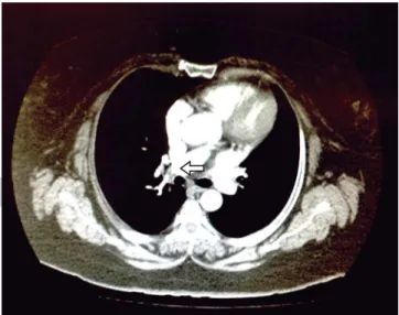 Figura 3. En la angiotomografía se observa la imagen hipodensa  en ramas segmentarias de la arteria pulmonar superior derecha  (fl echa), aunque con paso de medio de contraste.