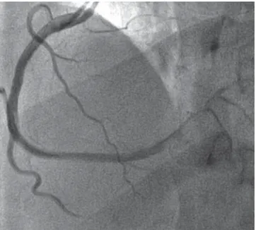 Figura 3. Misma proyección de la coronaria derecha posterior al  implante de un stent medicado en el segmento proximal que se  extiende al medio con adecuado fl ujo distal.