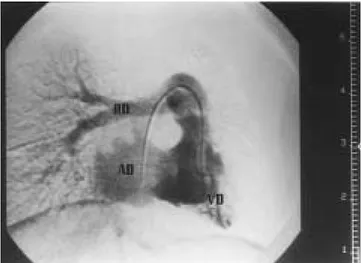 Figura 6. Aortograma por oclusión posterior al sitio del conducto arterioso, donde se aprecia importante flujo retrógrado del medio de contraste hacia el tronco pulmonar y rama derecha pulmonar, sin observarse la rama izquierda pulmonar; Ao: aorta; RD: ram