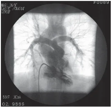 Figura 1. Ecocardiograma bidimensional de un enfermo con te- te-tralogía de Fallot característica