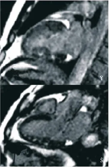 Figura 2. A) Imagen en eje corto que muestra lesión tipo parche 