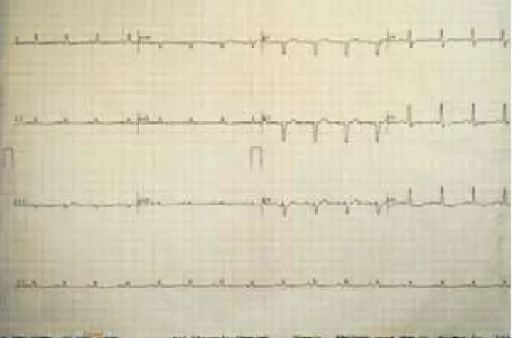 Figura 1. Electrocardiograma en el que se evidencia la presencia 