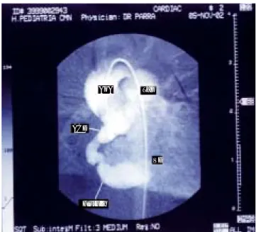 Figura 4. Coronariografía derecha posterior a colocación de se-