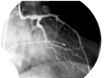 Figura 1. Angiografía de la coronaria izquierda en proyección obli-
