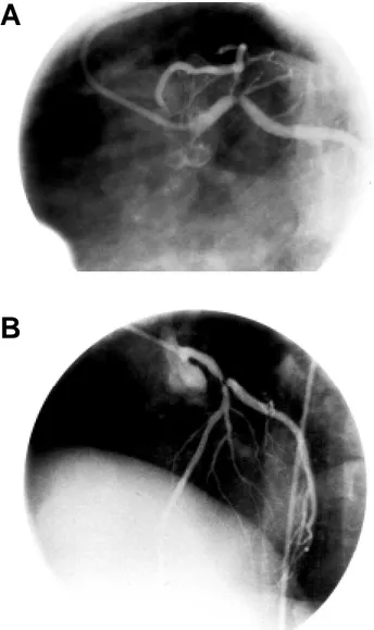 Figura 5. A: Reestenosis crítica del stent aplicado en la arteria des-