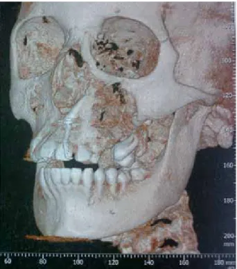 Figura 1. Ortopantomografía preoperatoria.