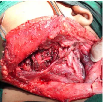 Figura 8. Abordaje cervical.Figura 7.