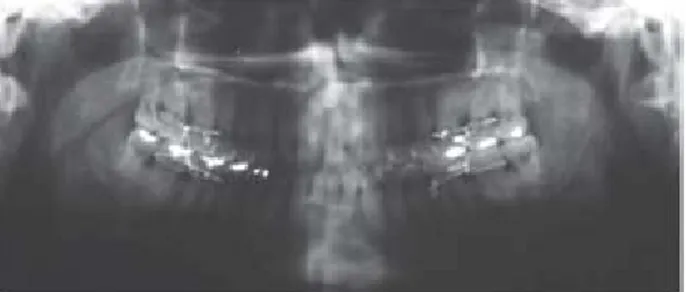 Figura 21. Vista radiológica postquirúrgica. Nótese el espa-