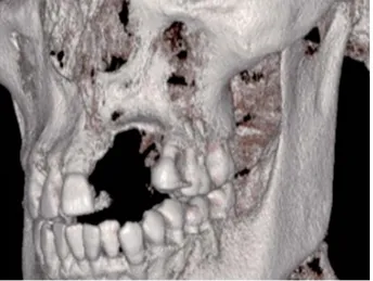 Figura 2. TAI óseo de mentón en bloque. Fijado con tornillos 
