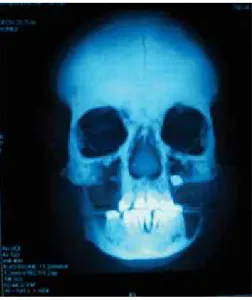 Figura 2. Se observa ortopantomografía con imagen radiolú-