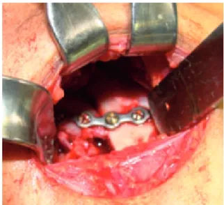 Figura 7. Lesión ósea transoperatoria.