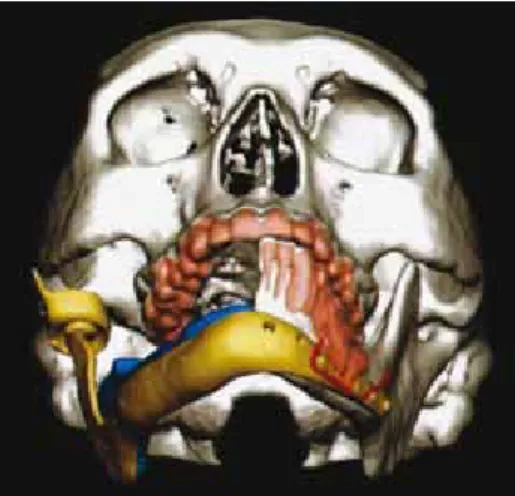 Figura 5. Diseño individual de prótesis hemimandibular de 