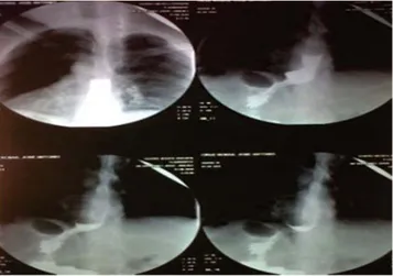 Figura 5. Esofagograma postquirúrgico de paciente masculino  de 52 años con adecuado paso, sin fugas ni retraso al medio de  contraste.