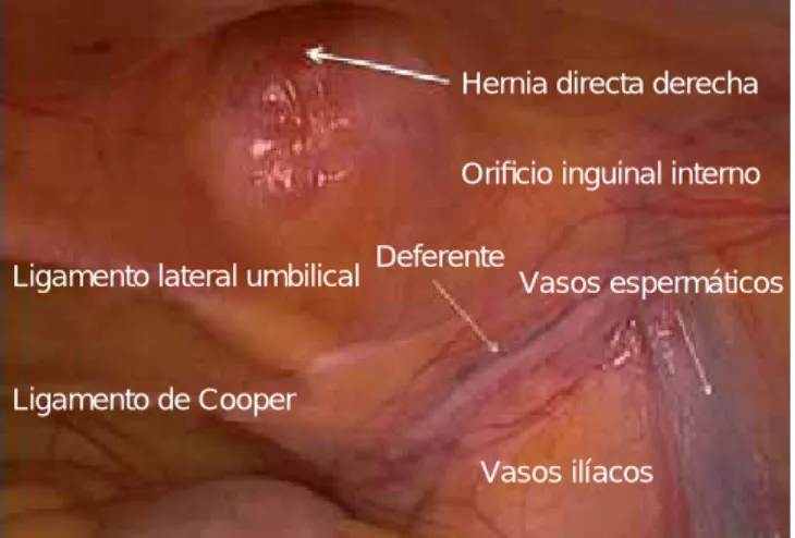 Figura 1. Anatomía inguinal derecha preperitoneal transabdomi-