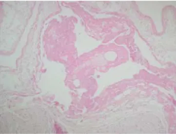 Figura 7-B.  Microfotografía del hilio renal donde se observa trombosis. Tinción de hematoxilina y eosina