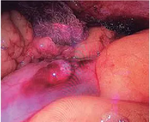 Figura 3. Cierre primario laparoscópico con nudo intracorpóreo. Figura 2. Lesión en colon grado II según AAST y hemoperitoneo.