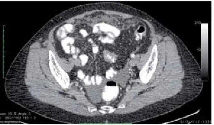 Figura 3. TAC abdominopélvica con doble contraste. Líquido li-