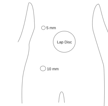 Figura 2. Colocación de trócares para recto.