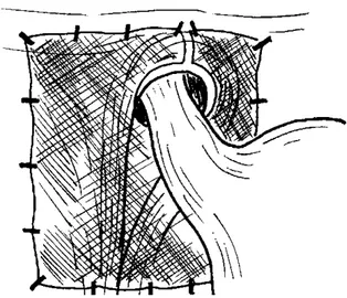 Figura 3. Cierre de pilares sin tensión malla extendida (onlay) sobre los pilares del hiato alrededor del esófago, sin cierre de pilares.