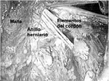 Figura 3. Malla plegada hacia arriba, anillo herniario y elementos del cordón sin evidencia de lesión pre-peritoneal.
