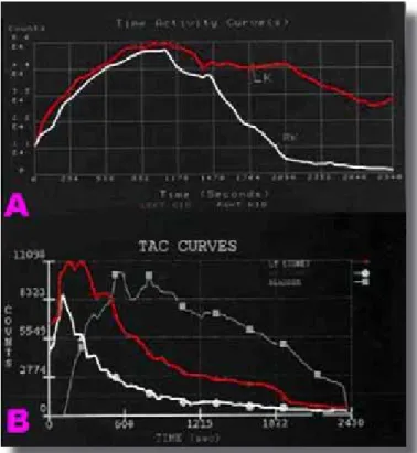 Figura 1. (A)  El gamagrama renal con MAG-3 al  cuarto mes de vida mostró curva renográfica con   tiempo de vaciamiento retardado del lado izquierdo