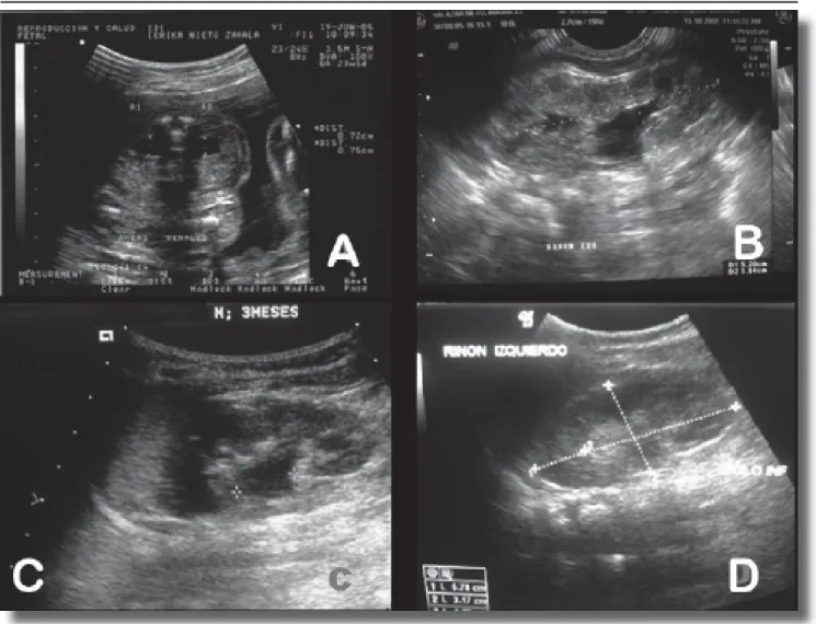 Figura 2.  Ultrasonido prenatal a las 23 semanas de gestación (A), con dilatación pielocaliceal  bilateral
