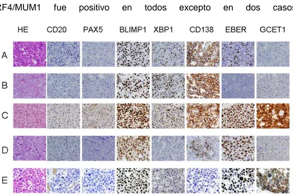 Figura  9.  Perfiles  de  expresión  inmunohistoquímica  en  linfoma  plasmablástico.  (A) Fenotipo plasmablástico completo (positividad para PRDM1/Blimp1,  XBP1s  y  negatividad  o  positividad  débil  para  CD20  y  PAX5),  con  expresión  de  CD138  y  