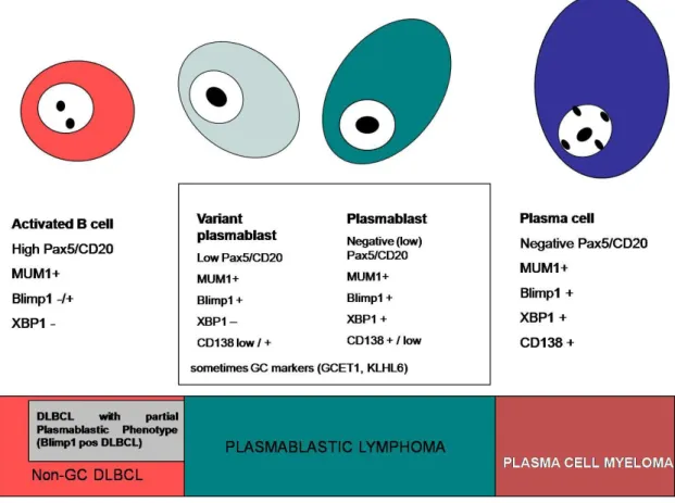 Figura  15  (de  referencia(3)):  El  uso  de  un  panel  de  IHQ  que  incluye  PAX5,  CD20,  PRDM1/Blimp1  y  XBP1s  permite definir  un  inmunofenotipo  plasmablástico  que  se  expresa  de  forma  variable  en  los  casos  de  linfoma  plasmablástico