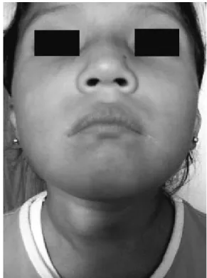 Figura 1. Facies característica: nótese la punta nasal bulbosa, narinas antevertidasy dismorfia de pabellones auriculares.