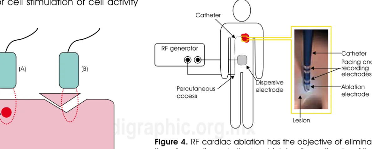 figure 3. (A) RF ablation refers to a procedure in which electri- electri-cal energy is applied to biologielectri-cal tissue through electrodes,  producing an elevation of the local temperature capable  of  producing  a  thermal  lesion