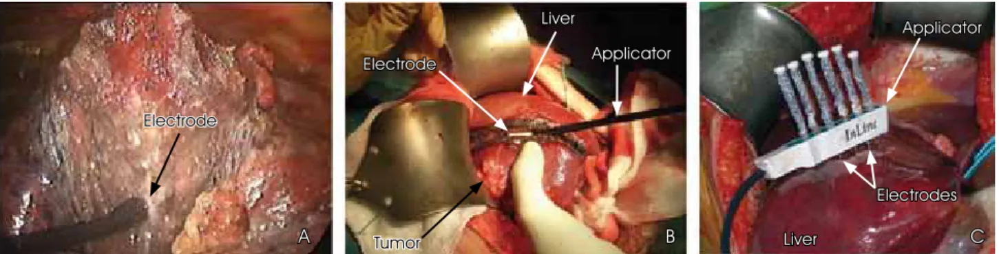 figure 5. Examples of RF current applicators designed to minimize bleeding during resection of the tumorous part of an  organ