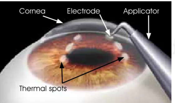 figure 7. During RF conductive keratoplasty (CK), a small size  electrode is inserted in the cornea