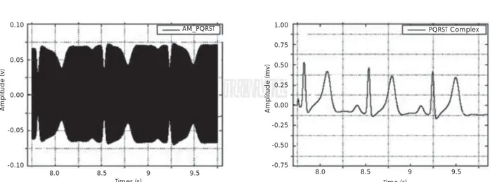 Figure 5. (A) and (B). Graphs of modulated (m = 0.75) and demodulated ECG signals acquired by the audio input via wireless.