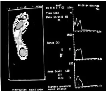 Figura 1. Baroplantometría computarizada normal.
