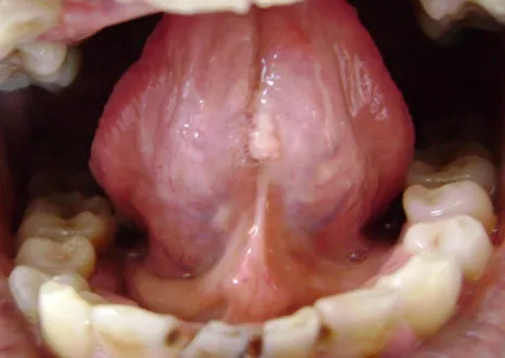 Figura 1. Neoformación exofítica de color blanquecino localizada en la cara inferior de la lengua,  con un diámetro máximo de 7 mm 