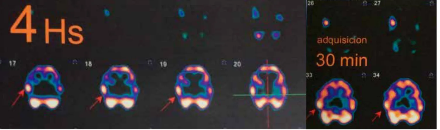 Figura 2.  Tomografía computarizada por emisión de fotones simples (SPECT) cerebral en el 2015 en esta hospitalización que  reveló hipocaptación en polo anterior del lóbulo temporal derecho.