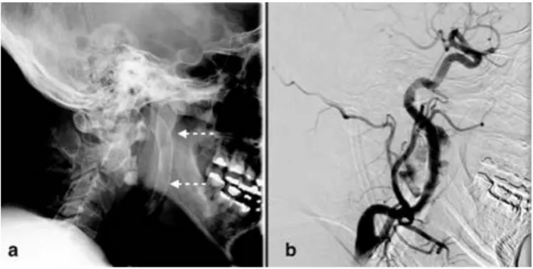 Figura 3.  Angiografía cerebral de la arteria carótida interna en proyección lateral que revela la colocación de  Wallstents telescopados (flechas punteadas) en el segmento cervical de la arteria carótida interna derecha (a) y 