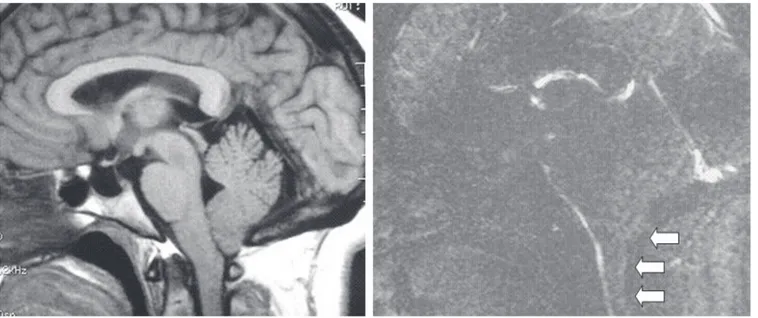 Figura 1.  RM y cine-RM de una paciente con cefalea tusígena y malformación de Chiari en la que se observa  dificultad del paso del líquido cefalorraquídeo por delante y por detrás en la región del agujero magno.