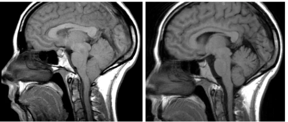 Figura 2.  A: Descenso amigdalar en paciente con cefalea tusígena y cefalea ortostática tras una punción lumbar