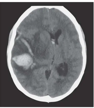 Figura 1. Tomografía axial computada de cráneo simple que muestra