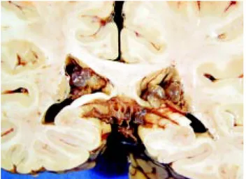 Figura 1. Vista basal del cerebro que muestra hernia tempo- tempo-ral medial bilatetempo-ral.