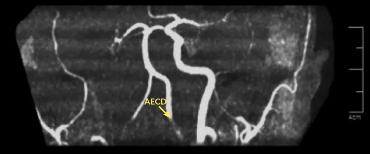Figura 2.  Angiorresonancia 3D. Se observa ausencia de señal de la arteria carótida interna derecha, identificando  adecuadamente la arteria carótida externa (ACED) ipsilateral y llenado adecuado de la arteria carótida interna y  externa contralateral.