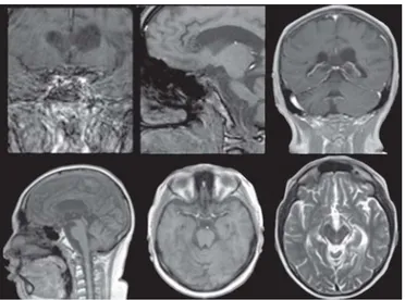 Figura 1.  Tomografía cerebral simple y contrastada. Muestra imagen sugestiva de tumoración en la región Selar.