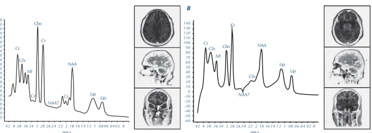 Figura 3. Espectroscopia por resonancia magnética cerebral que muestra importante reducción del n-acetilaspartato (NAA) e incremento de la colina