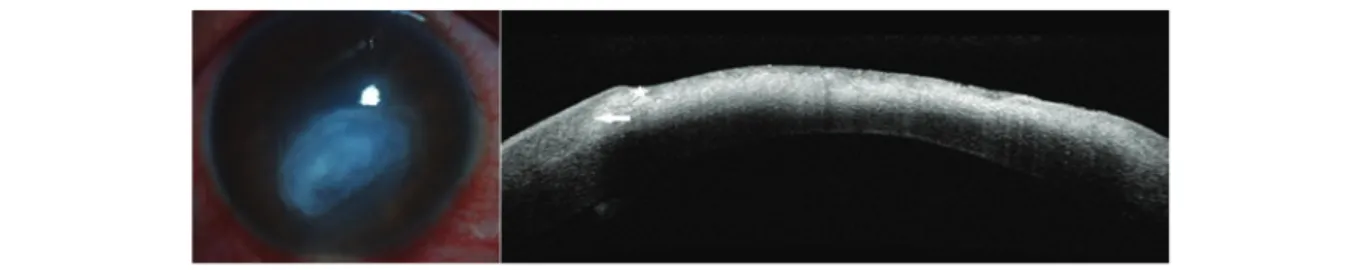 Figura 2.  Queratitis bacterianas: Hiperreflectividad subepitelial en el área de la lesión, pérdida de la diferenciación  de la capa epitelial y de la capa de Bowman (estrella), hiporreflectividad en el estroma subyacente a la lesión, con  adecuada diferen