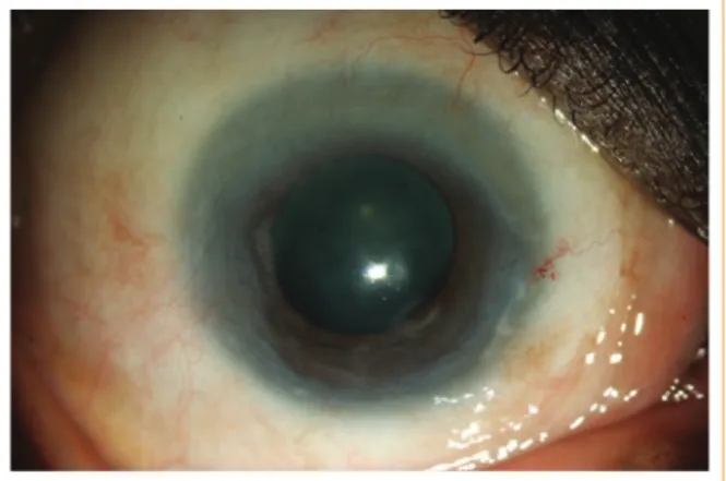 Figura 2. Dos meses después de iniciar el tratamiento  con esteroides tópicos, el ojo derecho del individuo con  PV mostrado en la  Figura 1 , demostró resolución del  pannus inflamatorio pero persistencia de la cicatrización  corneal anterior.