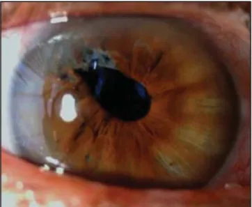 Fig. 1. Daño del estroma iridiano por el continuo prolapso del iris durante la facoemulsificación en un paciente con síndrome de iris flácido.