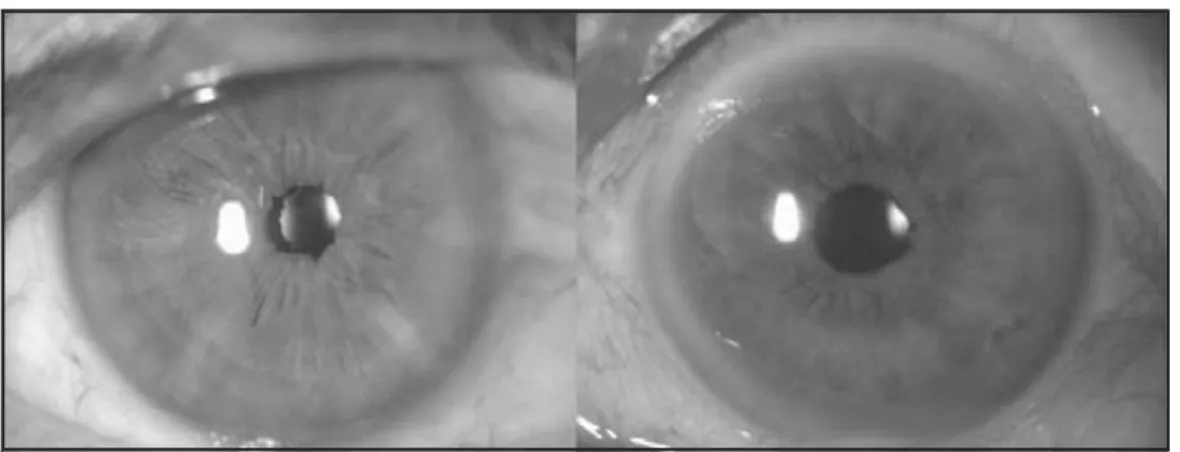 Fig. 4. Micro desgarros del esfínter pupilar después del uso del anillo de Malyugin.