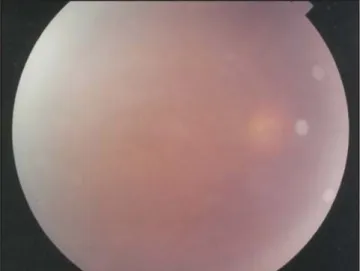 Fig. 1 Biomicroscopía de OD en que se observa hiperemia con-