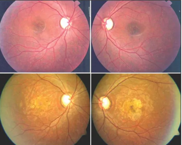 Fig. 1. Aspecto clínico de polo posterior AO. Imágenes superiores corresponden al momento del diagnósti-